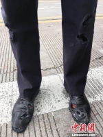 图为：被拖行后的雷晨磊裤子、鞋子等部位全被磨破。　钟李佳 摄 - 浙江新闻网