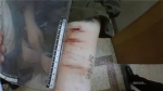 杭州四个95后手臂割伤眼圈发黑送医，警察推开他们房门，惊呼“不要命了！” - 杭州网