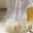 正常的血浆清澈透亮，是淡黄色透明状的；而从阿宁身体里过滤出的血浆，白花花一片，已经是乳白色的油脂了。 天台县人民医院供图 - 浙江网